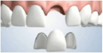 Dental bridge supported by crowns