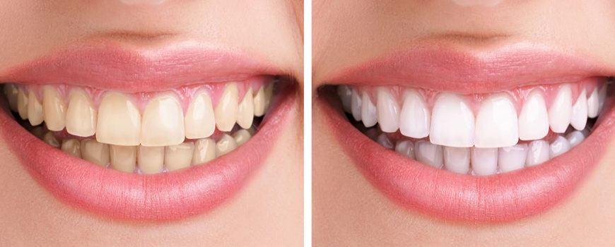 This is a general photo of a before and after whitening example. 