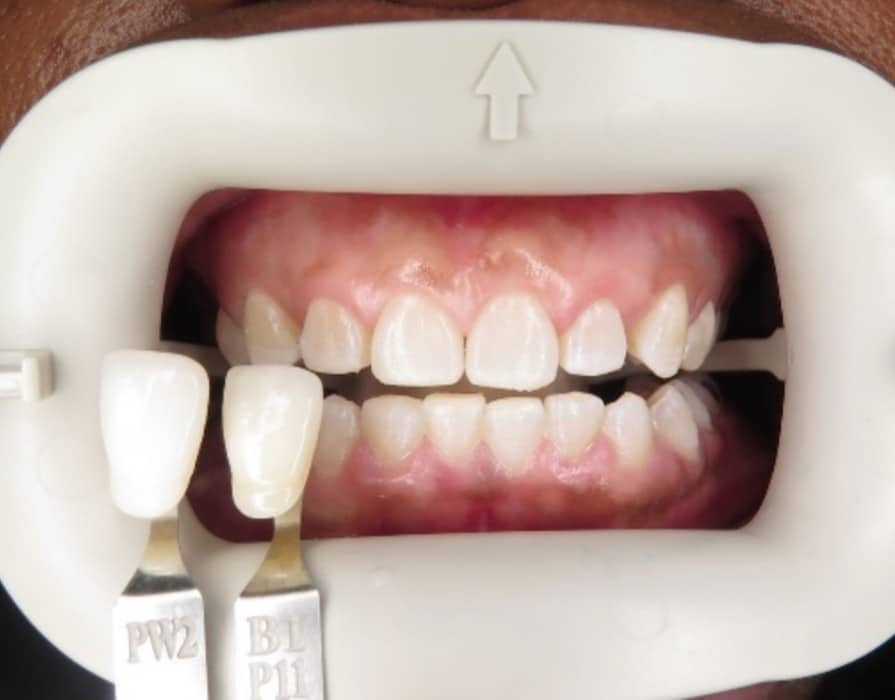 cs-teeth-result2