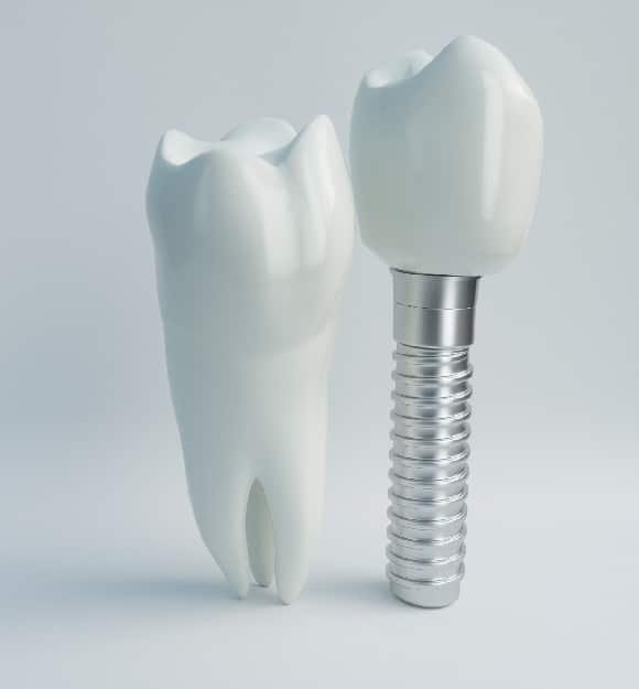 _What Are Incision-less Dental Implants_