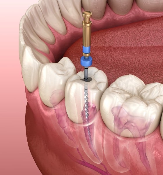 _What Is Endodontic Therapy_