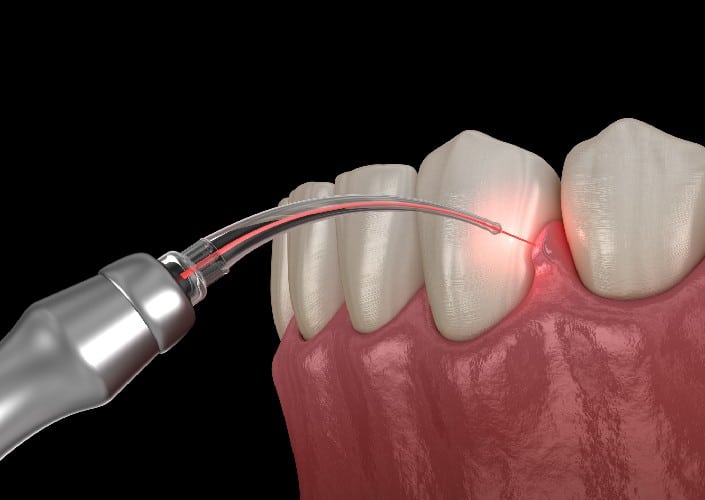 _Advantages of Laser Dentistry_