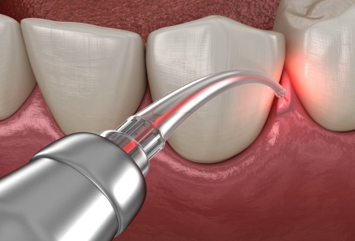 _Advantages of Laser Dentistry_