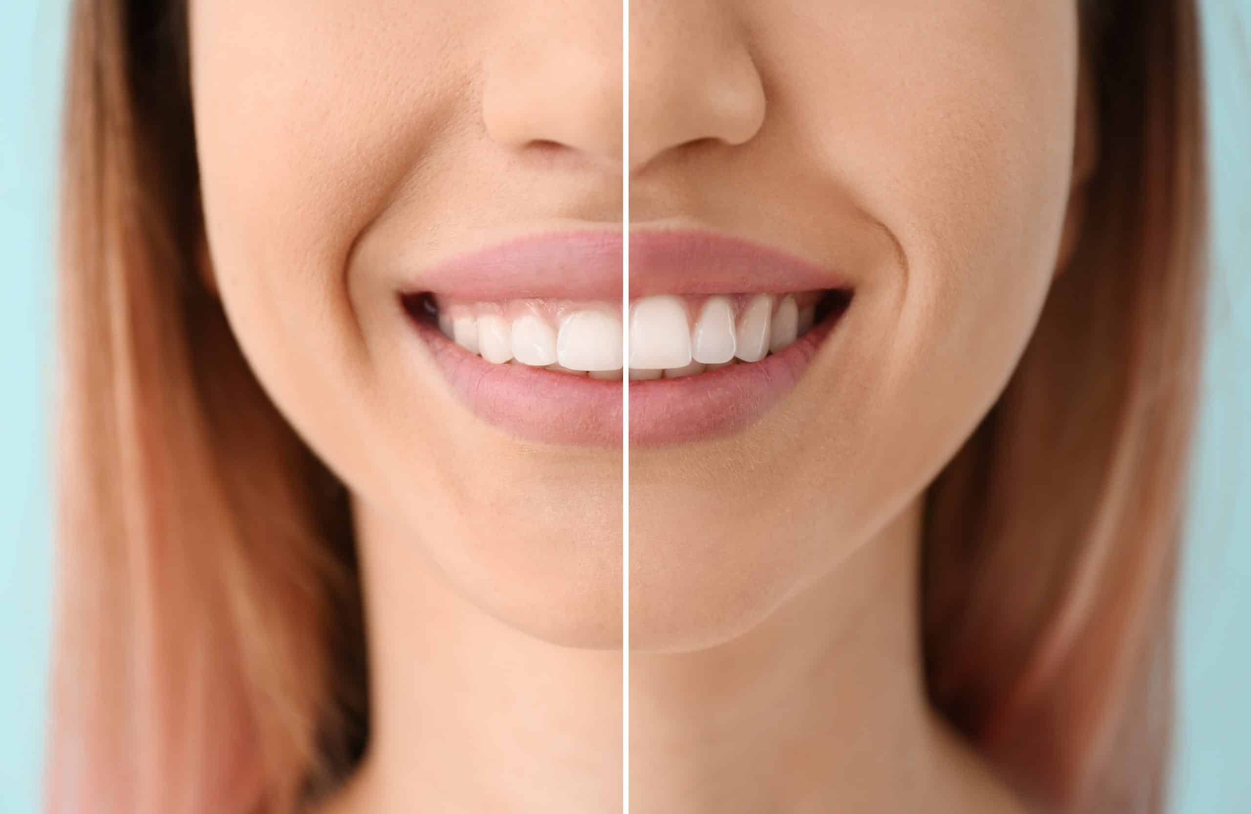 Young woman before and after procedure of gingival plasty, close
