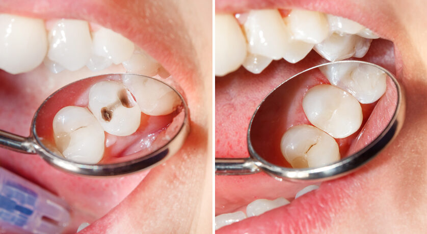 Metal-Free Fillings