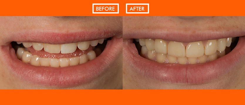Before and After