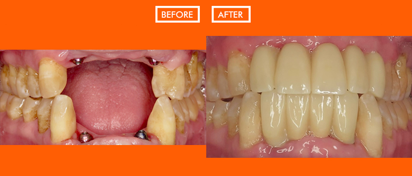 Before and After