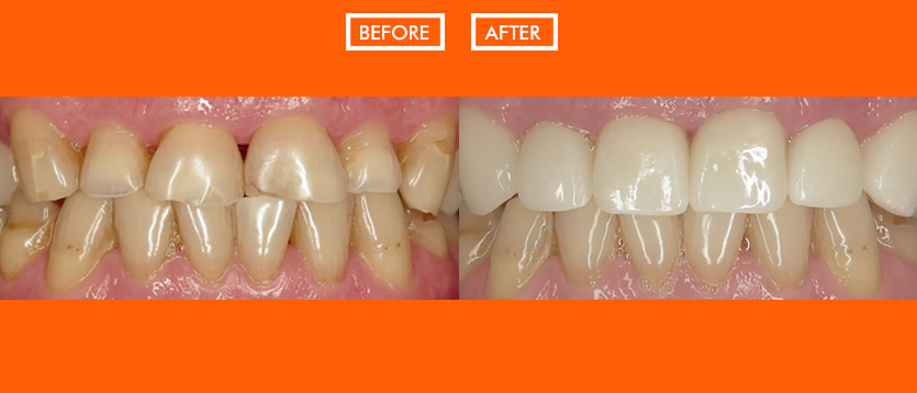 Before and After