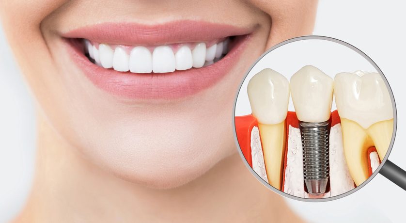 Mastering Dental Implants for a Confident New York Smile