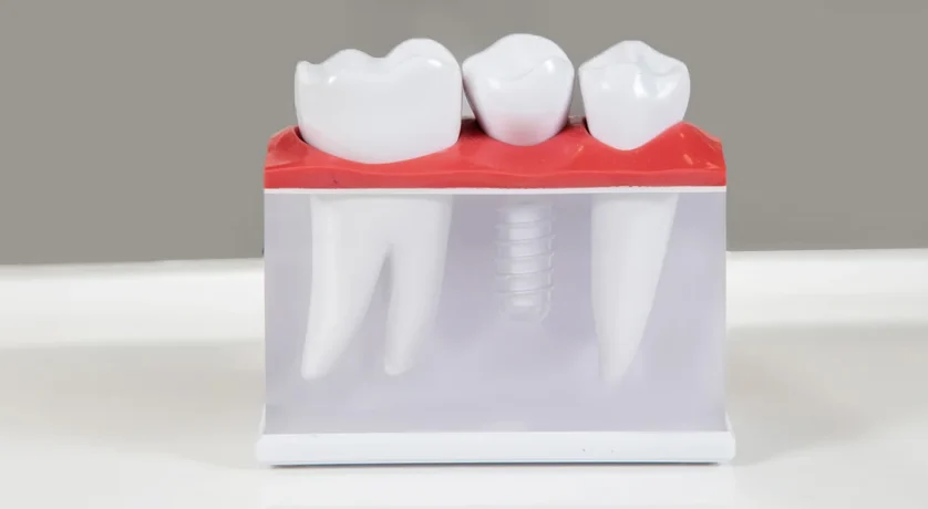 Why Are My Dental Implants Loosening? Causes, Fixes & Prevention